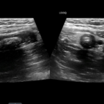 ultrasound image of an appendix