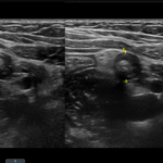 ultrasound image of an appendix