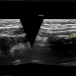 ultrasound image of an appendix