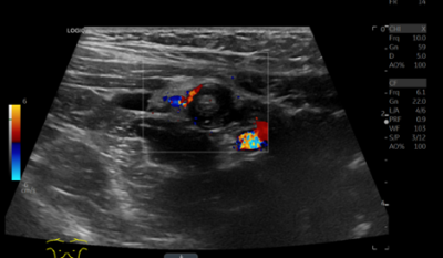 ultrasound image of an appendix